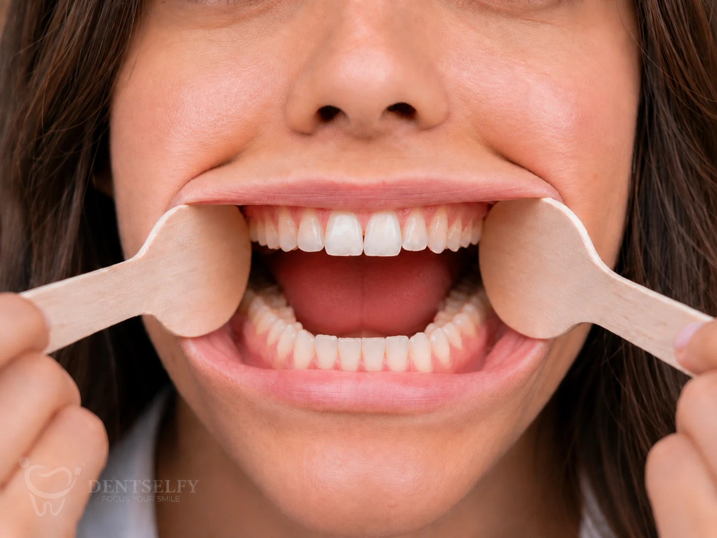 Open mouth view — upper and lower teeth clearly visible